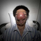 tumor_01_reuters