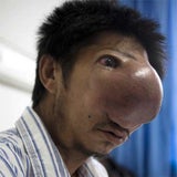 tumor_02_reuters