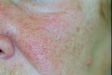 2 Laserbehandung bei Couperose Hernuss