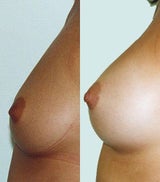 Vorher Nachher Prof Hernuss Brustvergrösserung Eigenfett