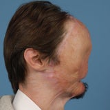 1. komplette Gesichtstransplantation