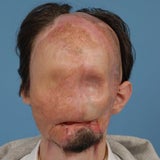 1. komplette Gesichtstransplantation