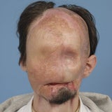 1. komplette Gesichtstransplantation
