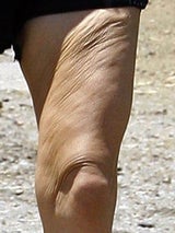 fergie_bein
