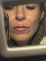 Das Endergebnis: Simone Lugner hat nun vollere Lippen.