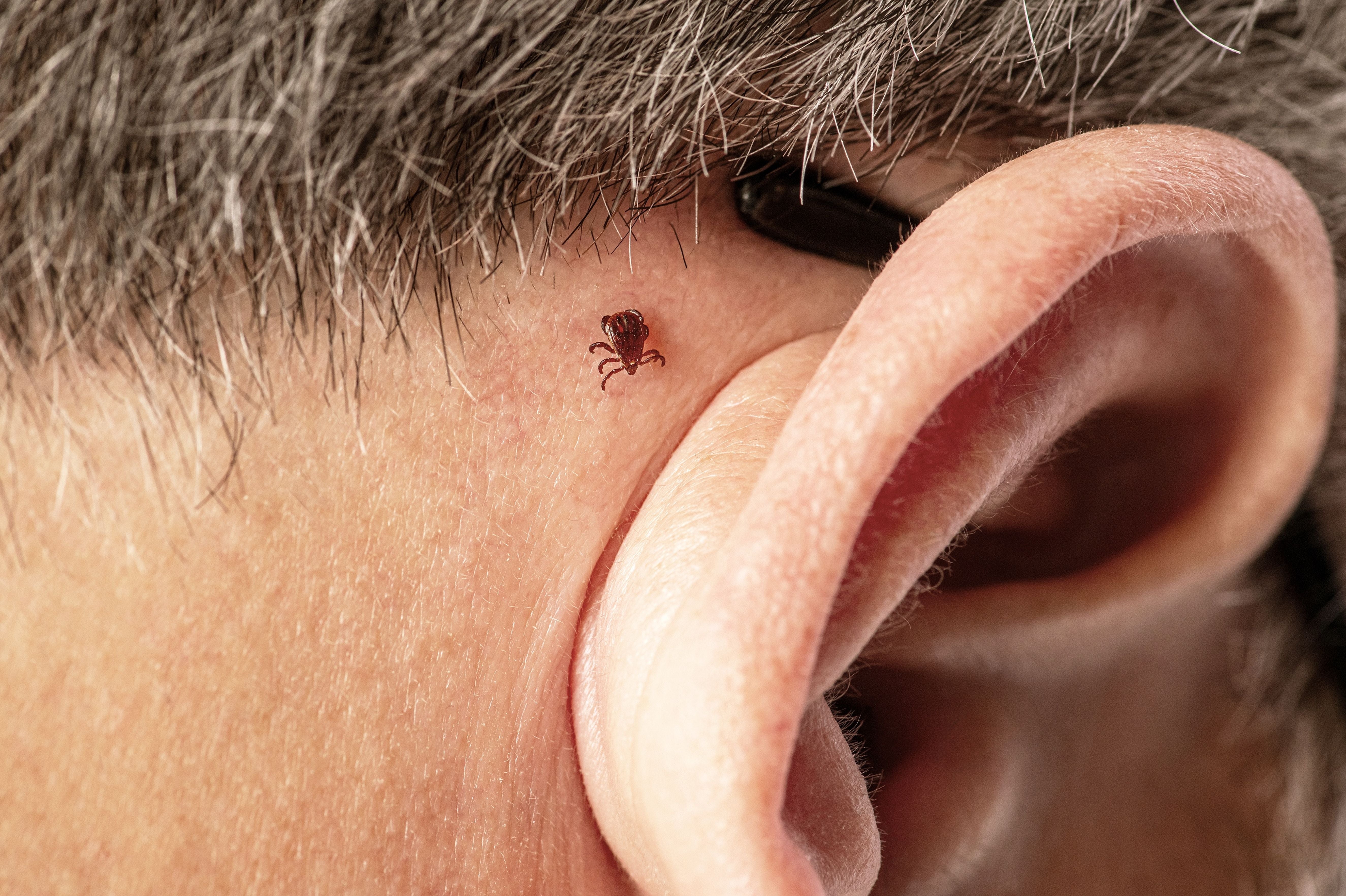 An adult female brown dog tick (Rhipicephalus sanguineus) crawls behind a person's right ear', '2023. Image courtesy CDC. (Photo by Smith Collection/Gado/Getty Images)