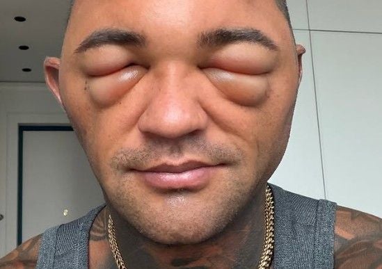Mann mit stark geschwollenen Augenlidern nach einer Transplantation.