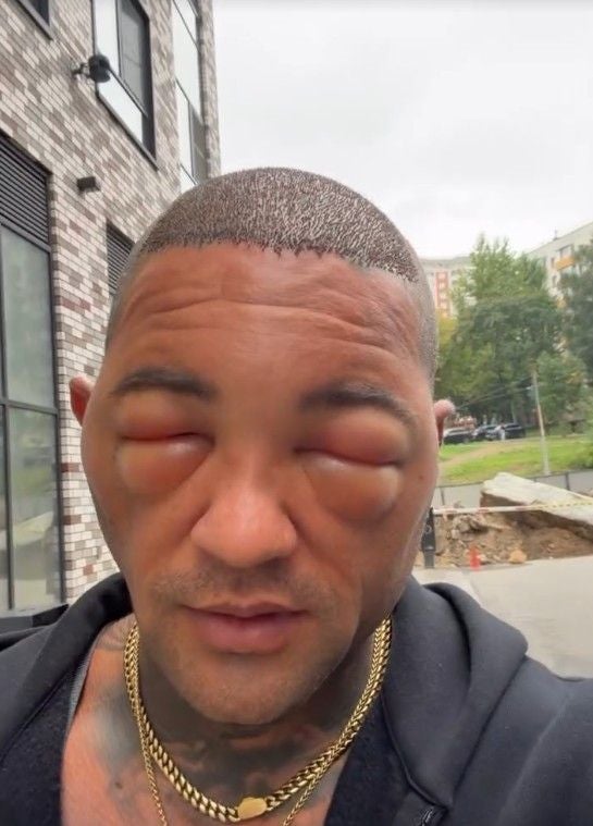 Mann mit stark geschwollenen Augen nach einer Transplantation im Freien.