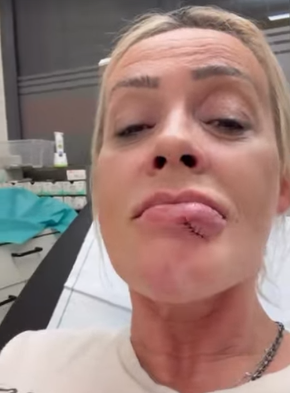 Frau mit genähter Wunde an der Unterlippe in einem Behandlungsraum.