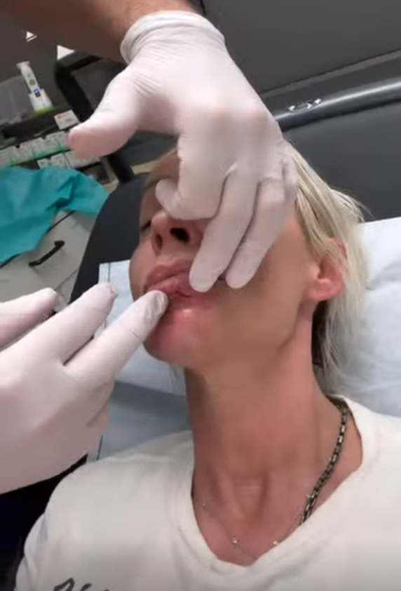 Frau erhält kosmetische Behandlung an den Lippen, Hände mit weißen Handschuhen berühren sie.