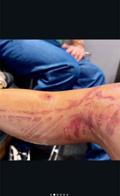 Arm mit Narben und Wunden; im Hintergrund sitzt eine Person in blauer Hose.